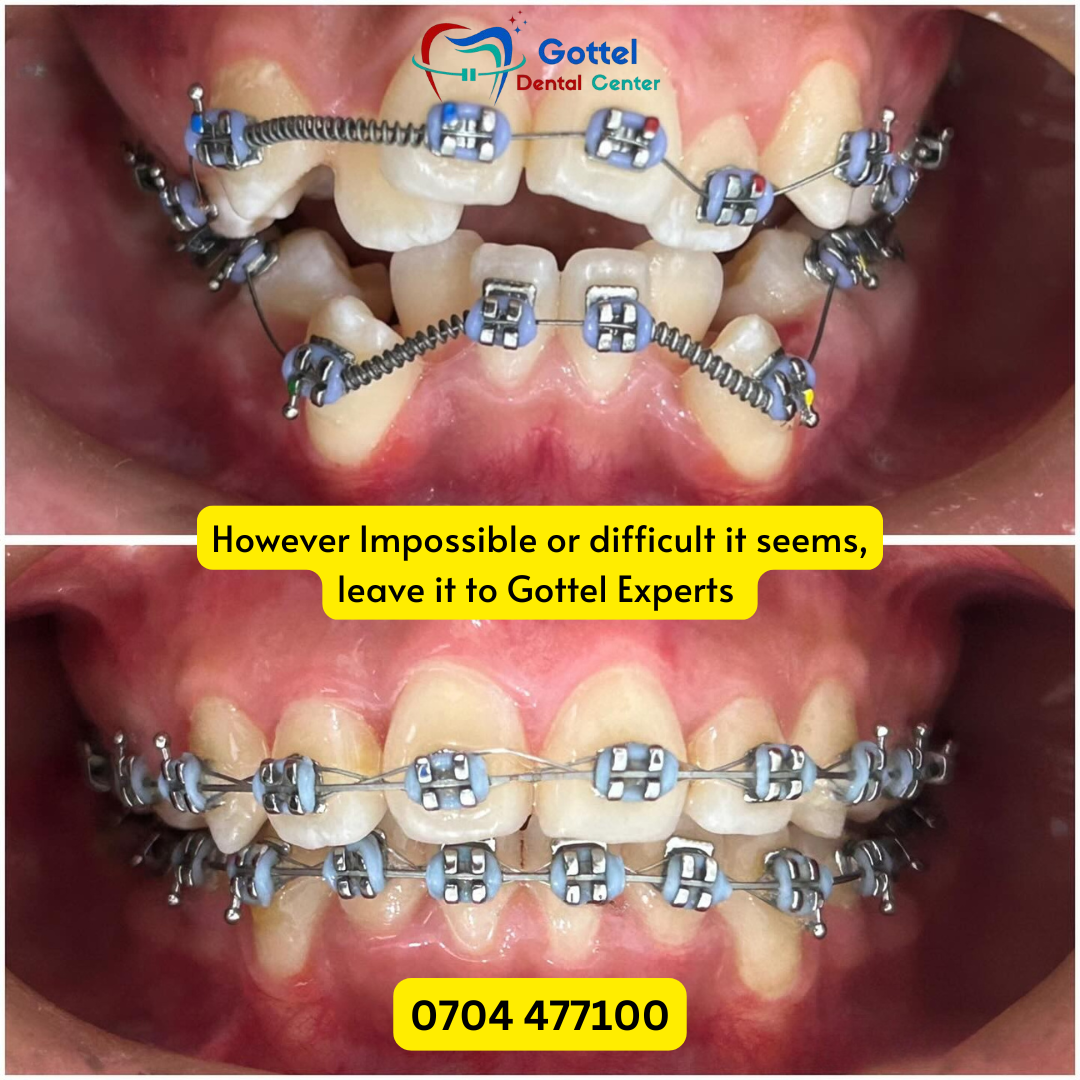 Braces transformation 2